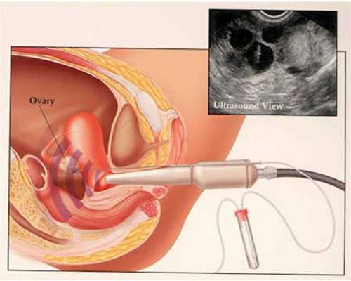 试管助孕前饮食调理多久