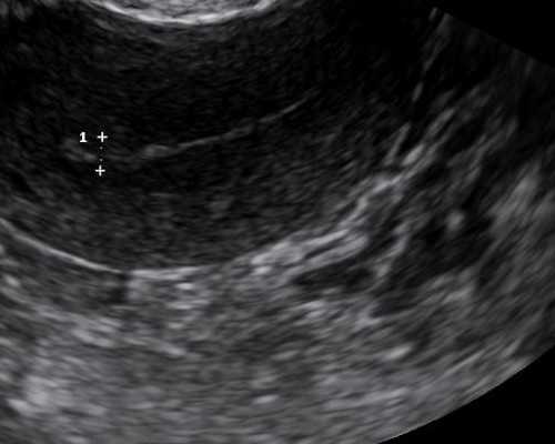 二代供卵试管_A89国际助孕,做试管婴儿需五条件试管婴儿移植后四注意_潍坊市生