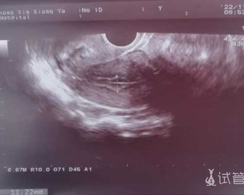 武汉怎样申请供卵,【武汉做供卵供卵代孕多少钱】来还愿了，千万不要套症状