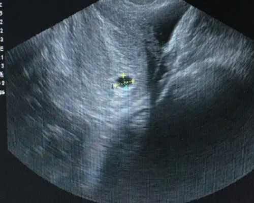 武汉代怀套餐最低价钱,武汉供卵试管助孕（试管助孕费用多少）